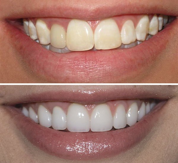 Blanchiment blanchiment dents - Coût, processus, suivi
