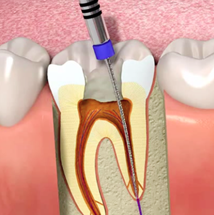 Временное пломбирование каналов зуба